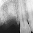 x-ray of right missing tooth
