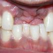 Missing Front 2 Teeth , Patient broke in an accident