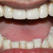 smile with confidence with immediate results
