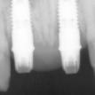 X Ray After