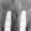 x-ray after 